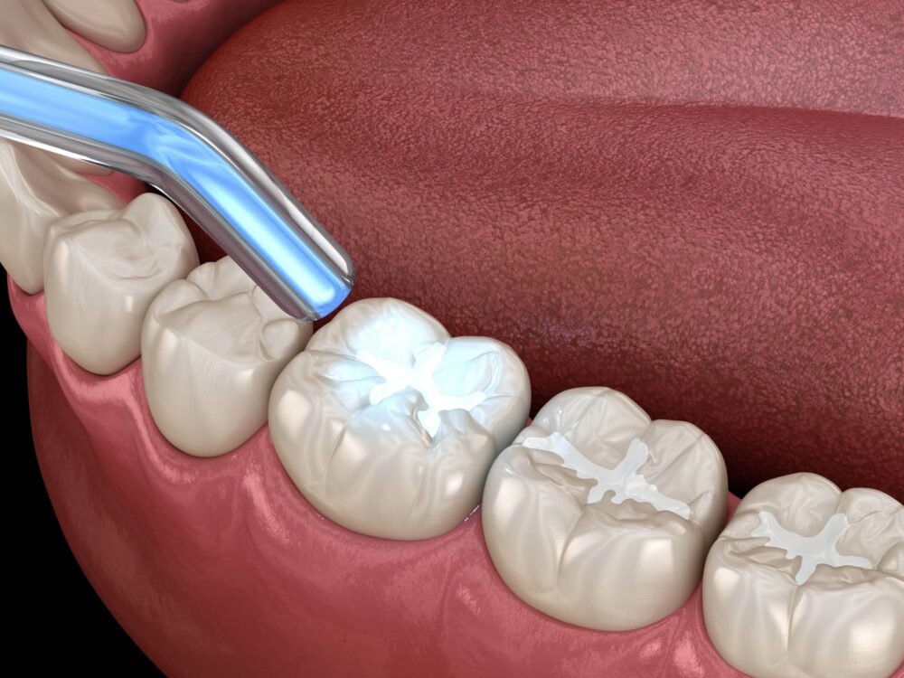 dental sealants wayzata