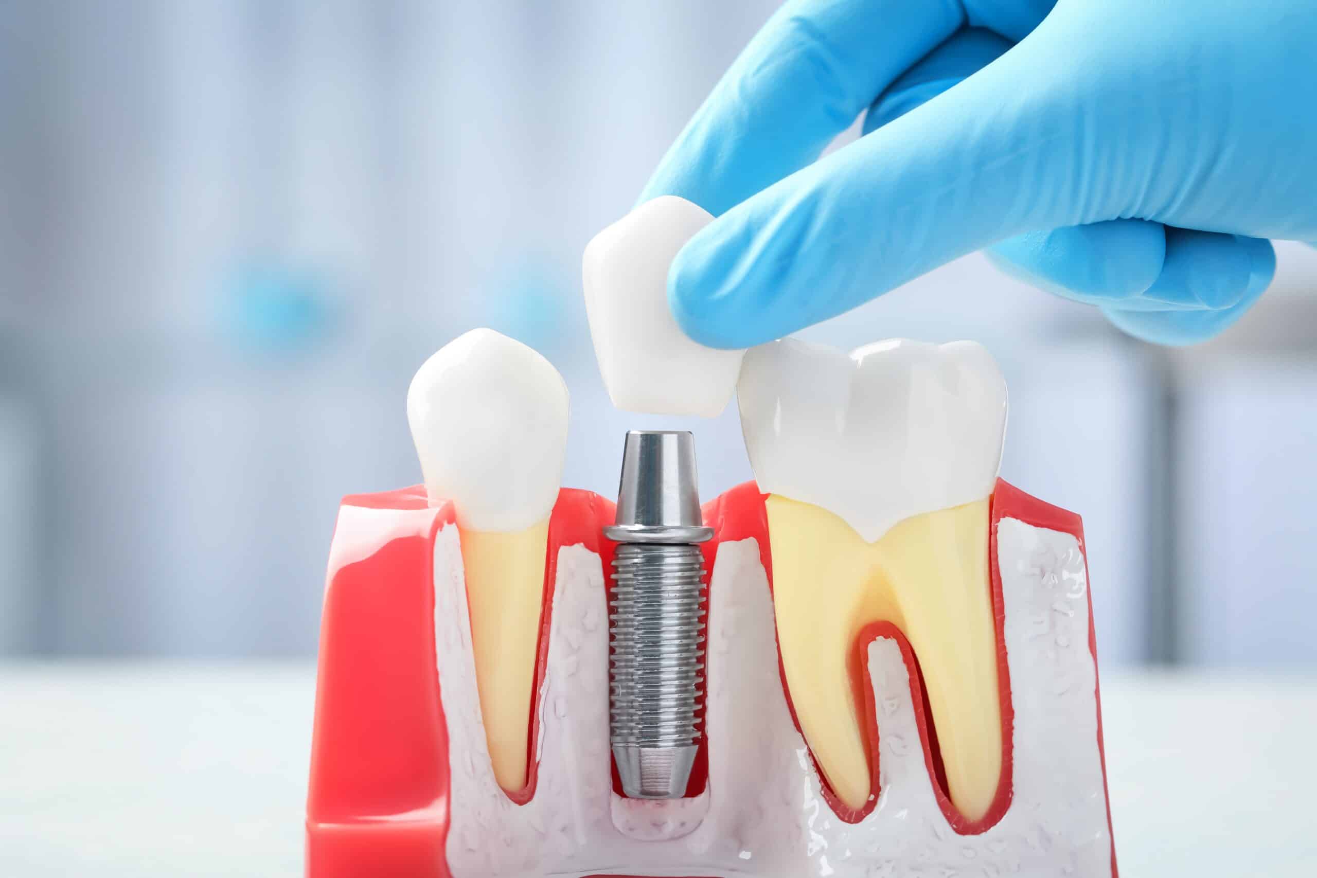 dental implants wayzata