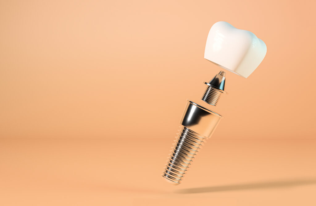 types of dental implants wayzata