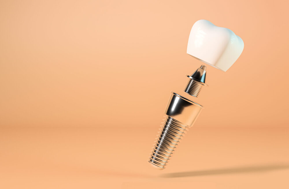 types of dental implants wayzata